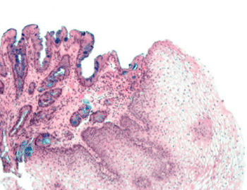 Image: Barrett's esophagus (left part of image). The characteristic goblet cells are stained blue. Normal stratified squamous epithelium is seen on the right of the image (Photo courtesy of Wikimedia Commons).